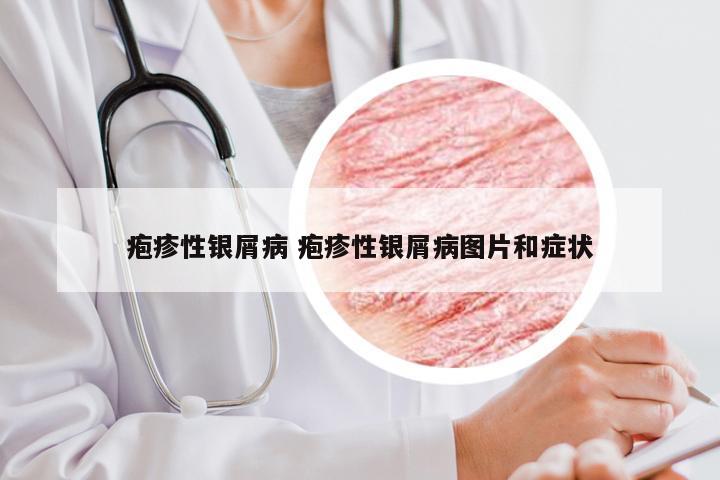 疱疹性银屑病 疱疹性银屑病图片和症状