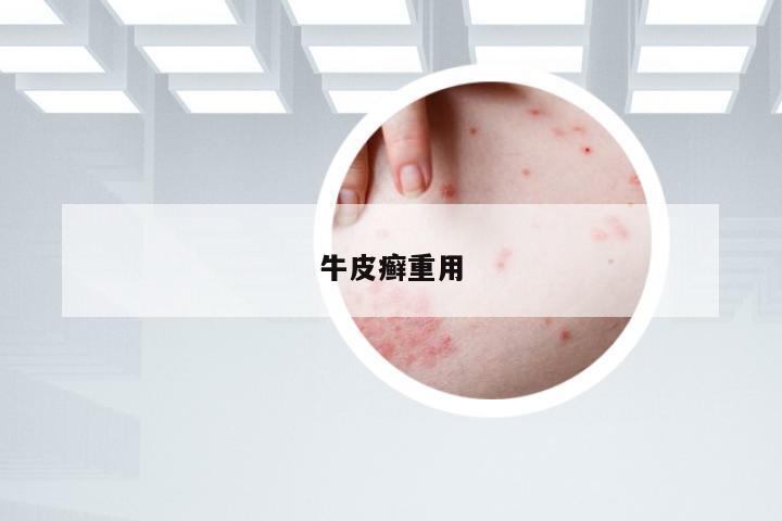牛皮癣重用