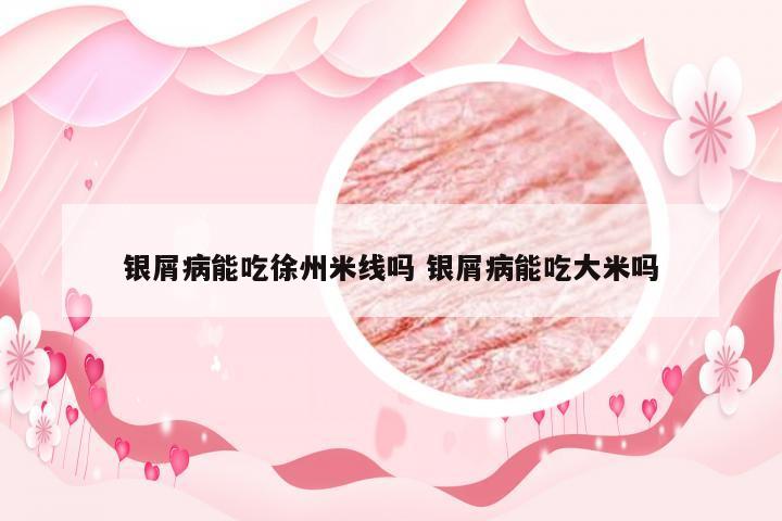 银屑病能吃徐州米线吗 银屑病能吃大米吗