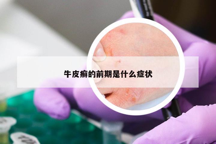 牛皮癣的前期是什么症状