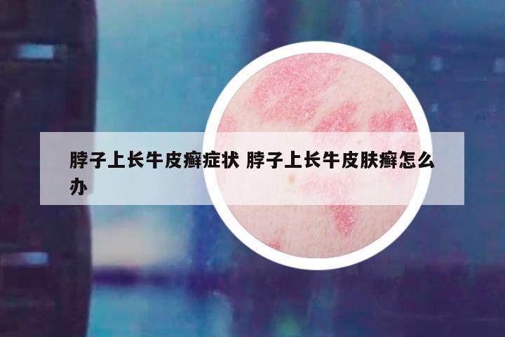 脖子上长牛皮癣症状 脖子上长牛皮肤癣怎么办