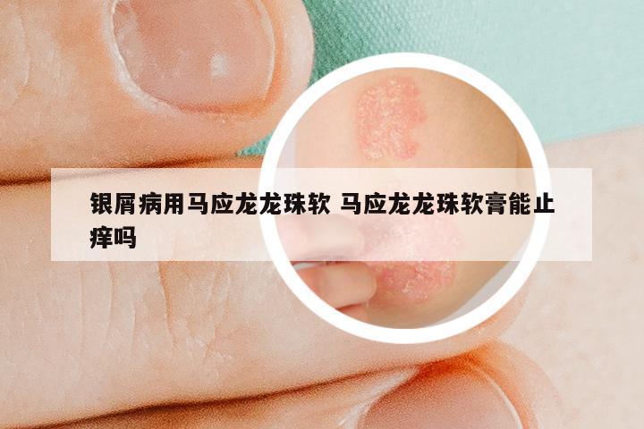 银屑病用马应龙龙珠软 马应龙龙珠软膏能止痒吗