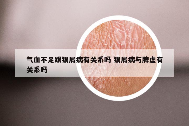 气血不足跟银屑病有关系吗 银屑病与脾虚有关系吗