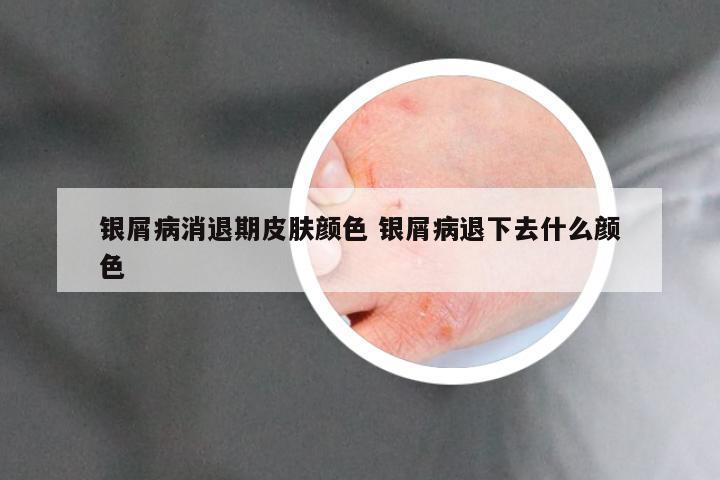 银屑病消退期皮肤颜色 银屑病退下去什么颜色