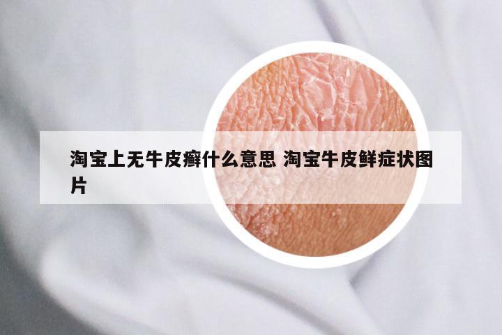 淘宝上无牛皮癣什么意思 淘宝牛皮鲜症状图片