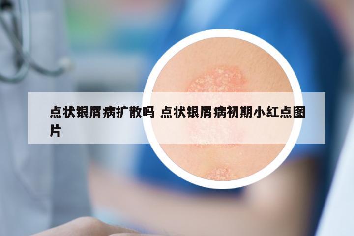 点状银屑病扩散吗 点状银屑病初期小红点图片