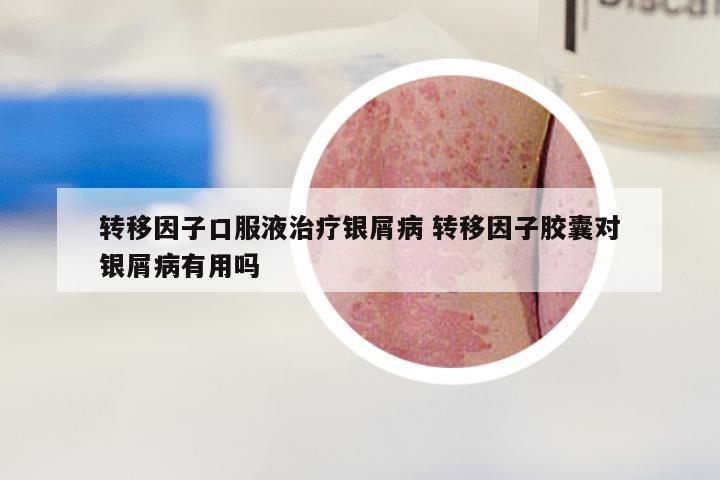 转移因子口服液治疗银屑病 转移因子胶囊对银屑病有用吗