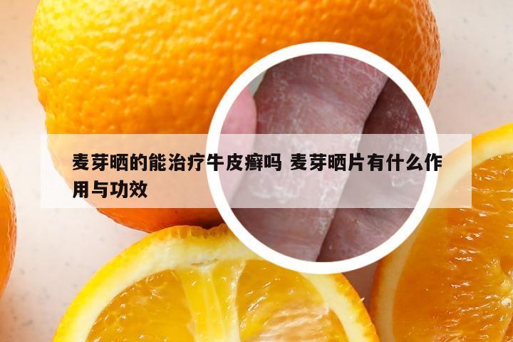 麦芽晒的能治疗牛皮癣吗 麦芽晒片有什么作用与功效