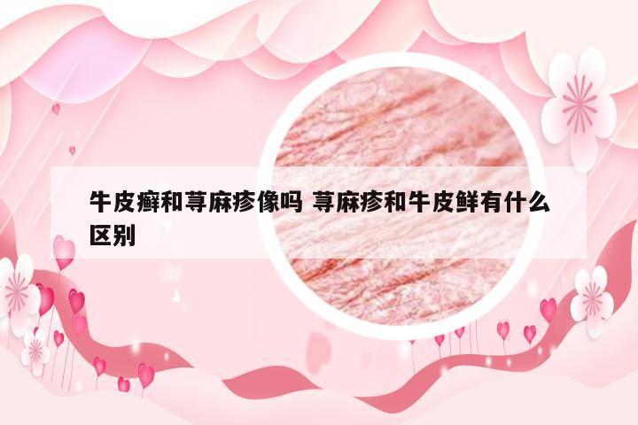 牛皮癣和荨麻疹像吗 荨麻疹和牛皮鲜有什么区别