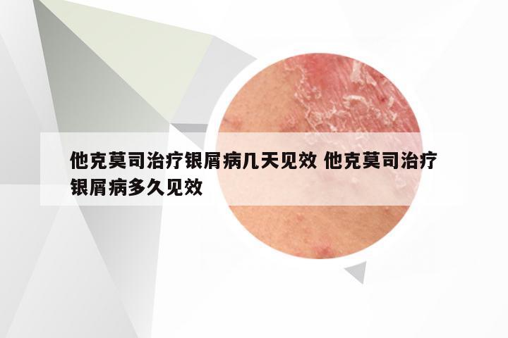 他克莫司治疗银屑病几天见效 他克莫司治疗银屑病多久见效