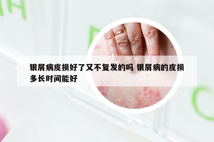 银屑病皮损好了又不复发的吗 银屑病的皮损多长时间能好