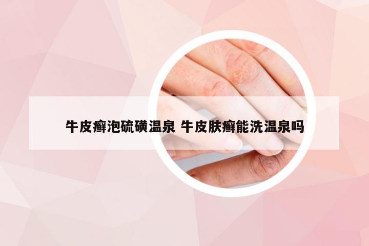 牛皮癣泡硫磺温泉 牛皮肤癣能洗温泉吗