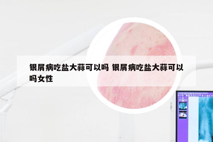 银屑病吃盐大蒜可以吗 银屑病吃盐大蒜可以吗女性