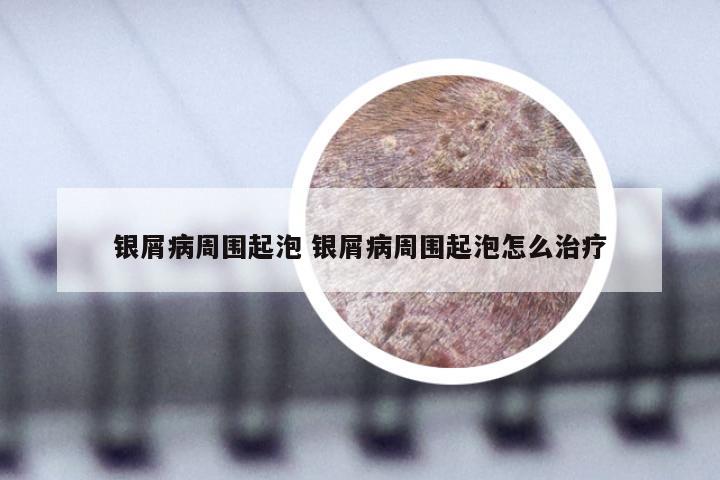 银屑病周围起泡 银屑病周围起泡怎么治疗