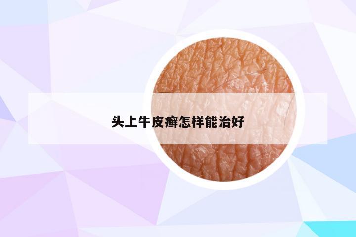 头上牛皮癣怎样能治好