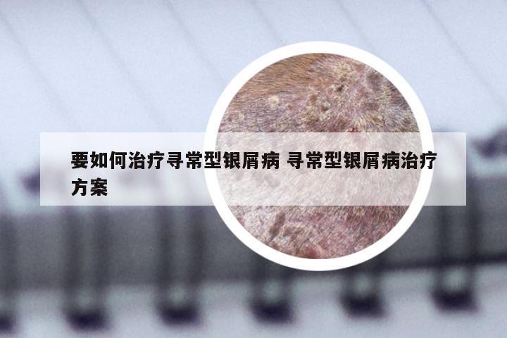要如何治疗寻常型银屑病 寻常型银屑病治疗方案