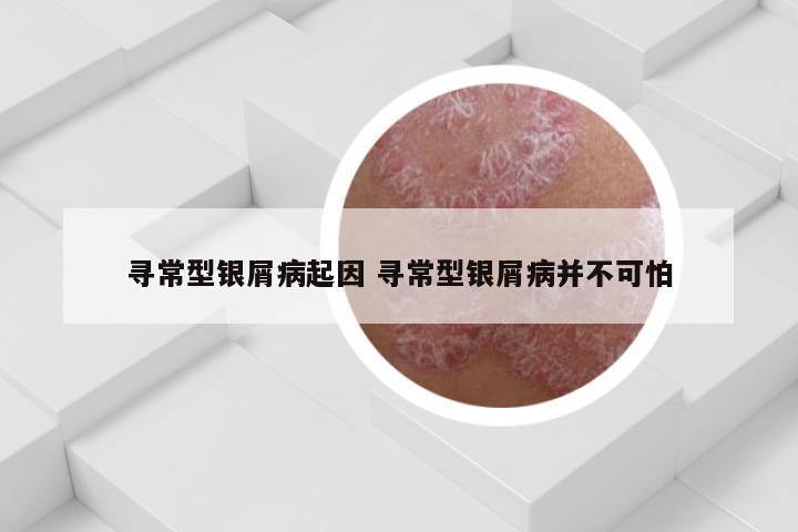 寻常型银屑病起因 寻常型银屑病并不可怕