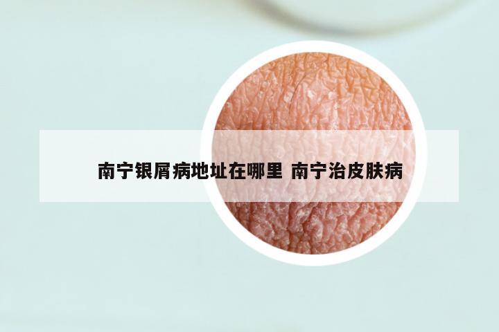 南宁银屑病地址在哪里 南宁治皮肤病