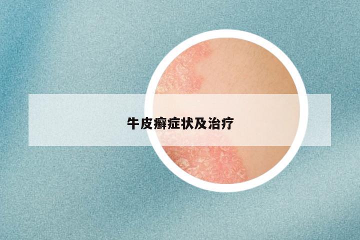 牛皮癣症状及治疗