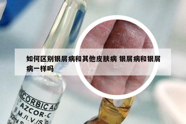 如何区别银屑病和其他皮肤病 银屑病和银屑病一样吗