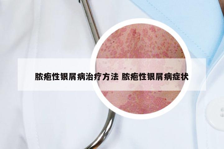 脓疱性银屑病治疗方法 脓疱性银屑病症状