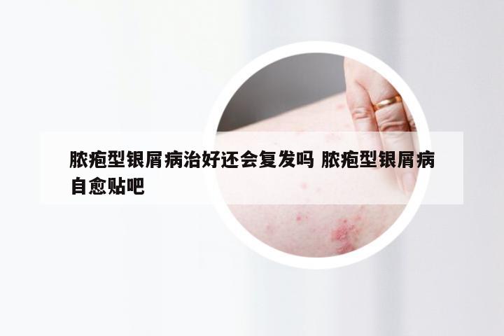 脓疱型银屑病治好还会复发吗 脓疱型银屑病自愈贴吧
