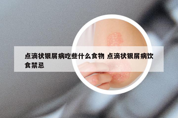 点滴状银屑病吃些什么食物 点滴状银屑病饮食禁忌