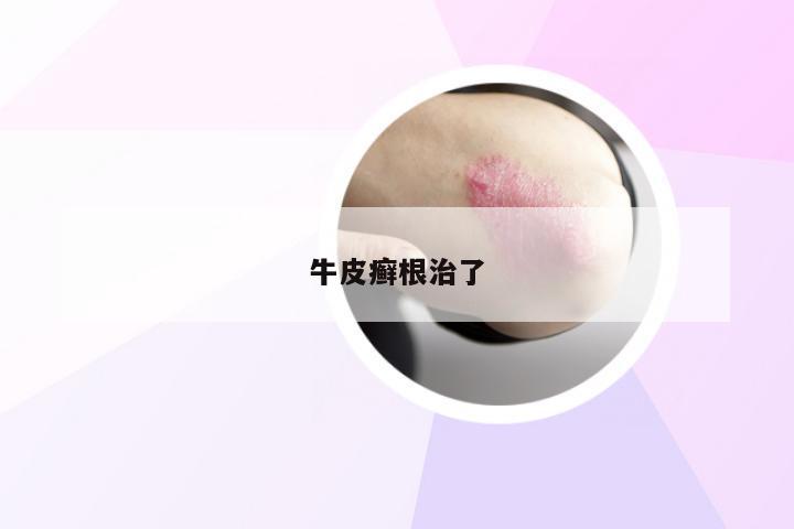 牛皮癣根治了