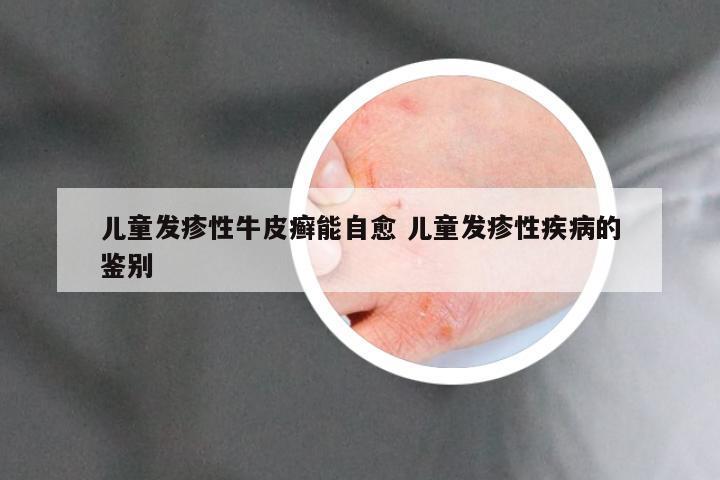 儿童发疹性牛皮癣能自愈 儿童发疹性疾病的鉴别