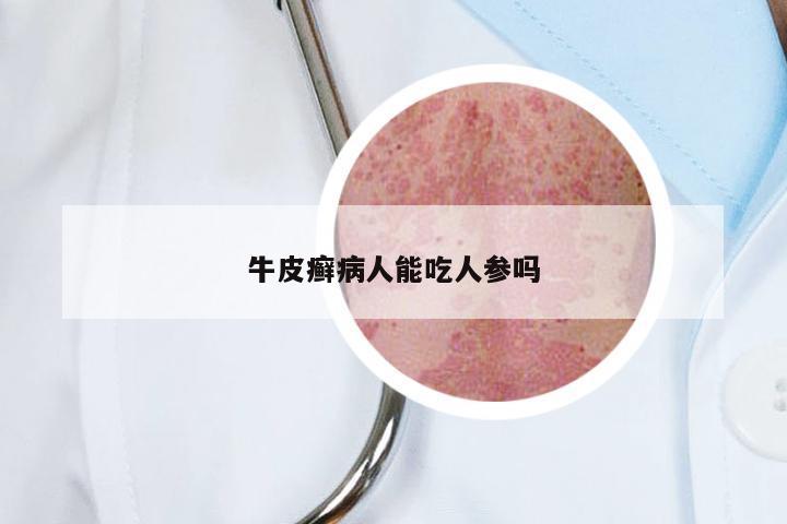 牛皮癣病人能吃人参吗