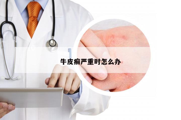 牛皮癣严重时怎么办
