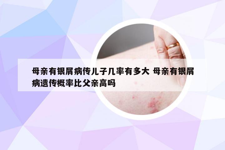 母亲有银屑病传儿子几率有多大 母亲有银屑病遗传概率比父亲高吗