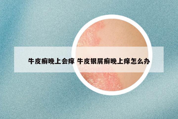 牛皮癣晚上会痒 牛皮银屑癣晚上痒怎么办