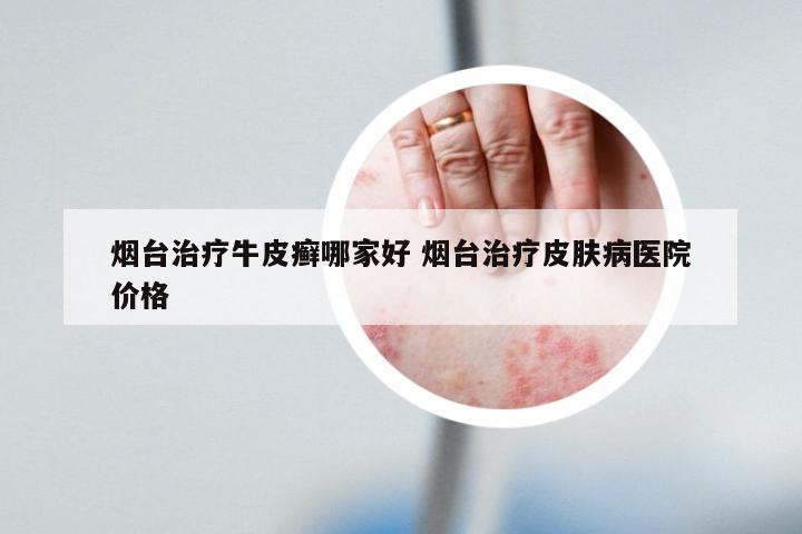 烟台治疗牛皮癣哪家好 烟台治疗皮肤病医院价格