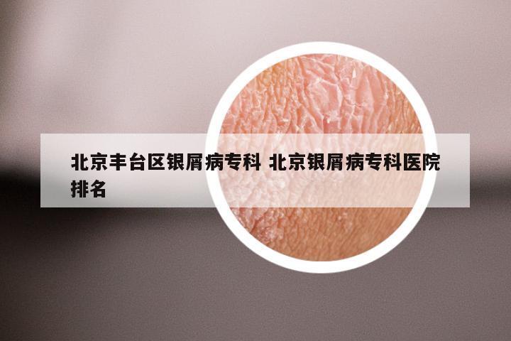 北京丰台区银屑病专科 北京银屑病专科医院排名