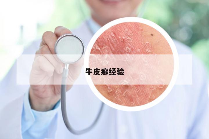 牛皮癣经验