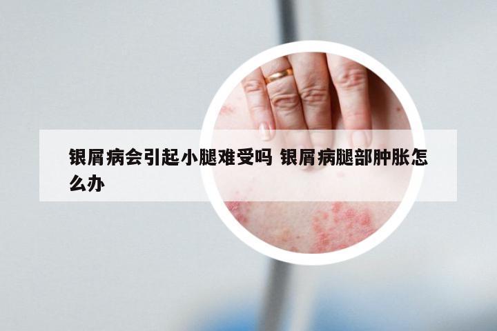 银屑病会引起小腿难受吗 银屑病腿部肿胀怎么办