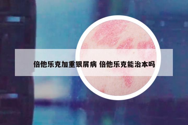 倍他乐克加重银屑病 倍他乐克能治本吗