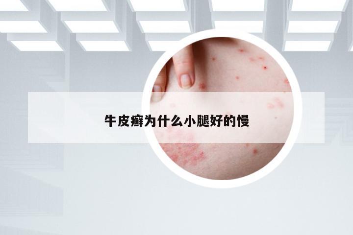 牛皮癣为什么小腿好的慢