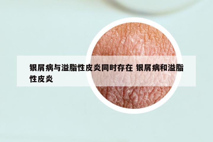 银屑病与溢脂性皮炎同时存在 银屑病和溢脂性皮炎
