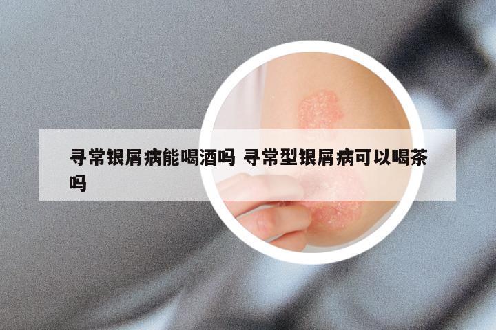 寻常银屑病能喝酒吗 寻常型银屑病可以喝茶吗