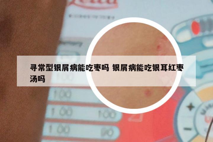 寻常型银屑病能吃枣吗 银屑病能吃银耳红枣汤吗