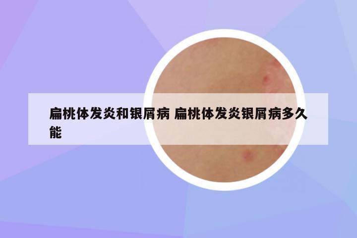 扁桃体发炎和银屑病 扁桃体发炎银屑病多久能