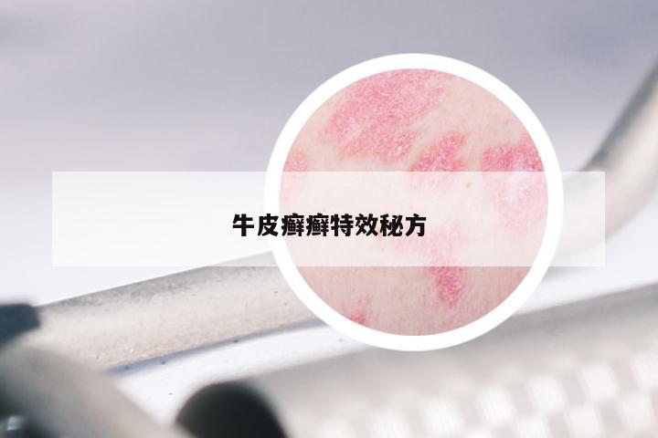 牛皮癣癣特效秘方