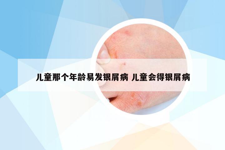 儿童那个年龄易发银屑病 儿童会得银屑病