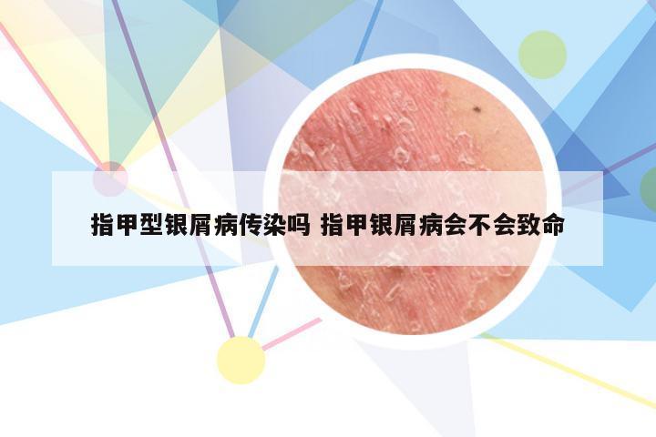 指甲型银屑病传染吗 指甲银屑病会不会致命