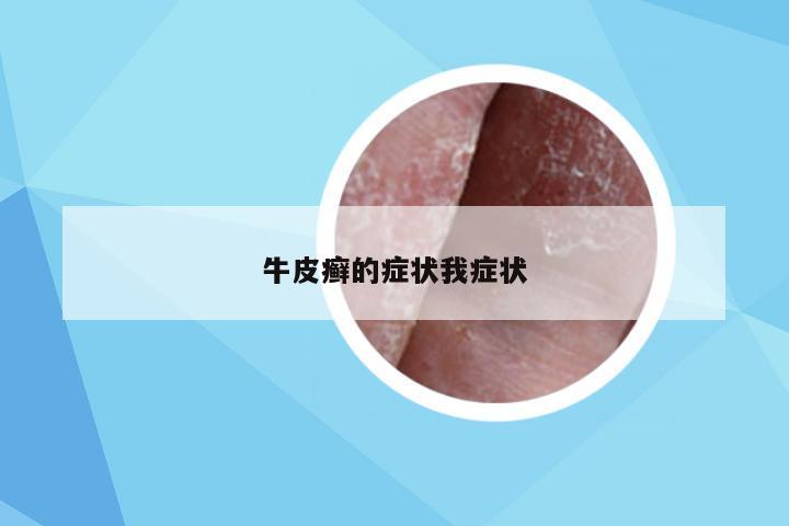 牛皮癣的症状我症状