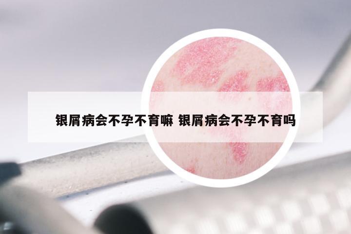 银屑病会不孕不育嘛 银屑病会不孕不育吗