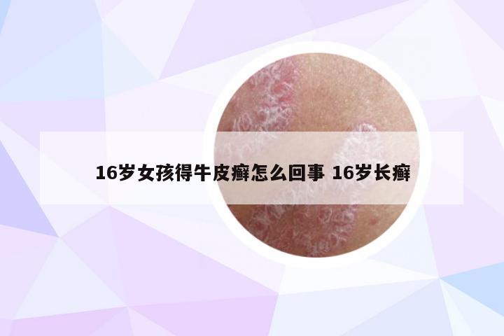 16岁女孩得牛皮癣怎么回事 16岁长癣