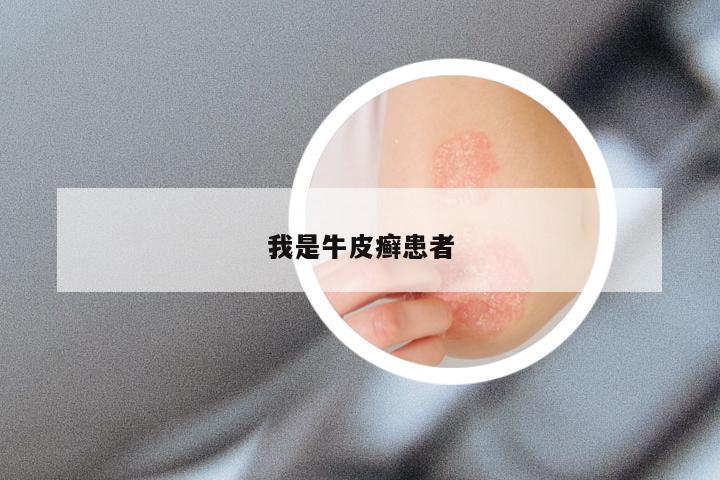我是牛皮癣患者